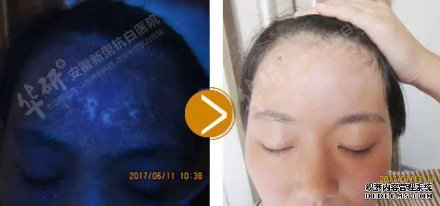 季节变化会影响白癜风的病情吗