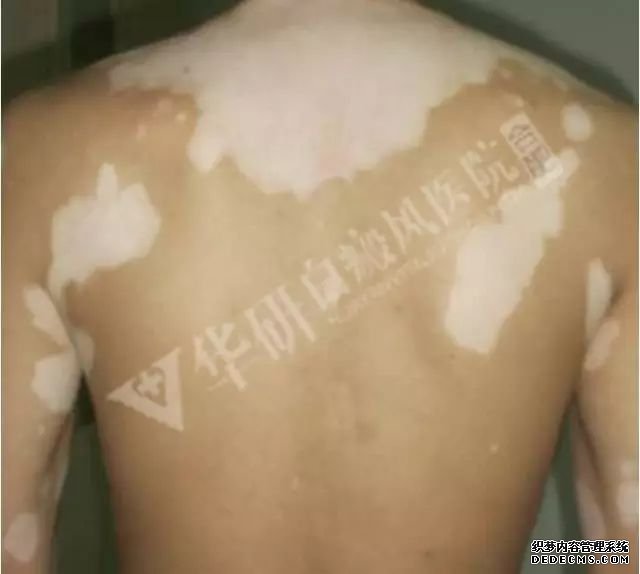 后背大片白癜风什么方法治好